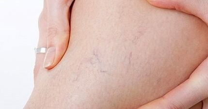 O estágio inicial das varizes nas pernas