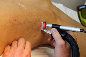 Métodos de tratamento de veias varicosas