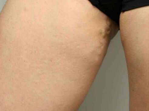 varizes da pelve durante a gravidez